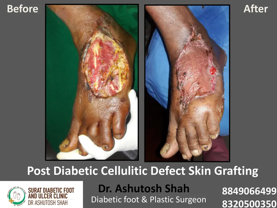 Diabetic Cellulitis and Coverage.pptx-3.webp